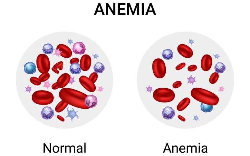 Anaemia